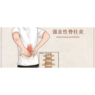 “不死的癌症”——强直性脊柱炎