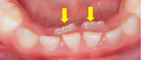 解密宝宝双排牙：竟是“吃太好”的锅？